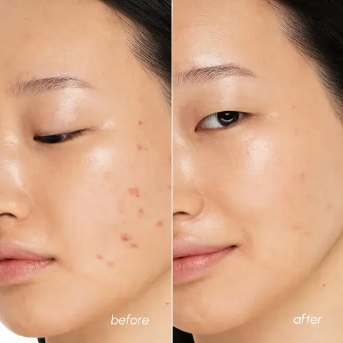 Before and After Maree Blemish Toner Polishes